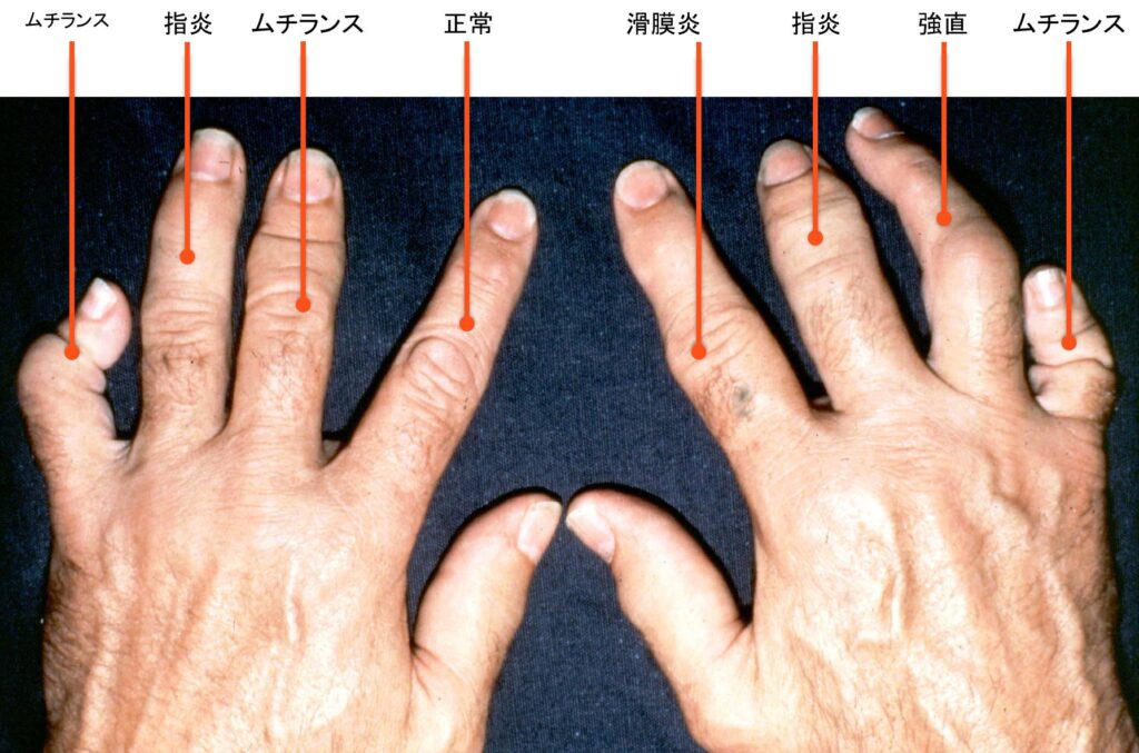 乾癬性病変と乾癬性関節炎はどのように関連していますか?