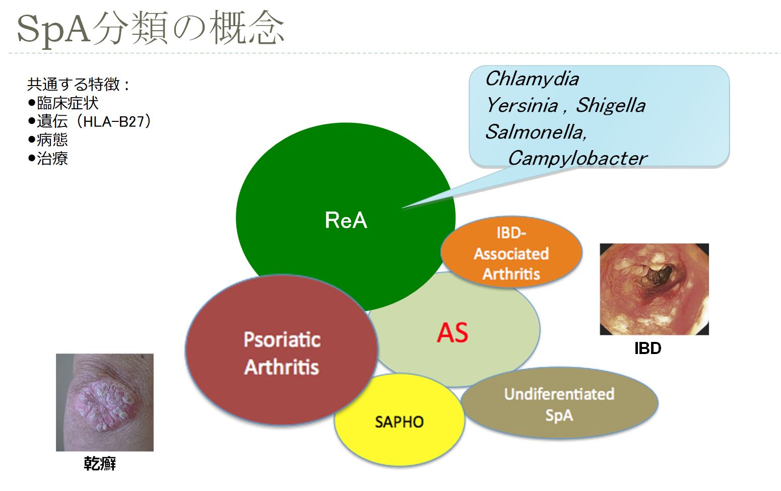反応性関節炎の治療